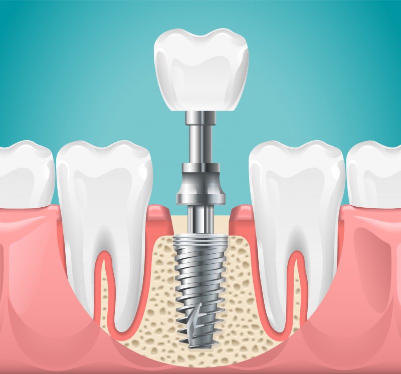 Diagram showing how a dental implant works