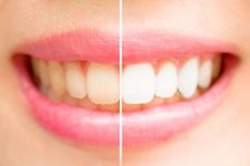 Tooth discoloration side-by-side comparison. 