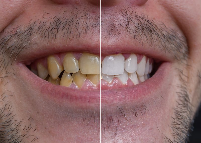 Before and after treatment of patient with yellow teeth