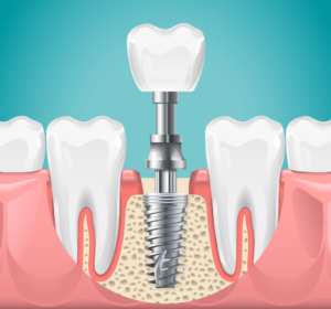 a closeup of a dental implant model